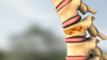 Spinal Wedge Compression Fracture Causing Pain