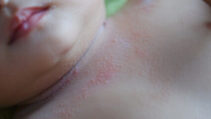 Severe prickly heat on the baby's neck.