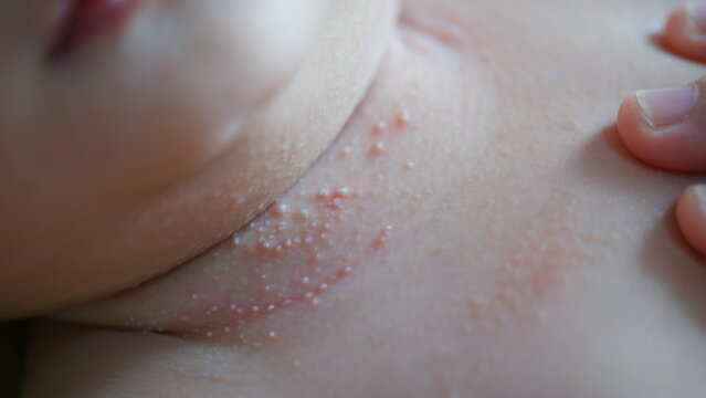 Severe prickly heat on the baby's neck.