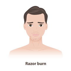 The man with razor burn on face and neck vector illustration. Razor bumps or Pseudofolliculitis barbae caused by shaving, lead to redness, irritation, ingrown hairs. Men skin care concept.