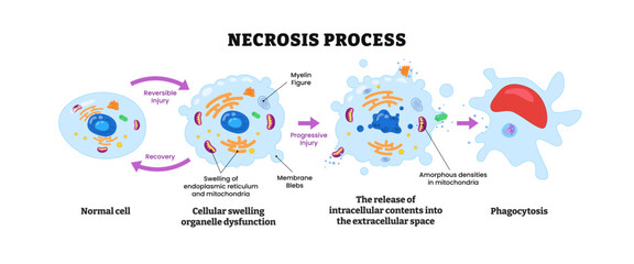 Necrosis process diagram infographic, labeled scheme with normal cell, cellular swelling organelle dysfunction, release intracellular, phagocytosis, recovery, death cell in body tissues. biology
