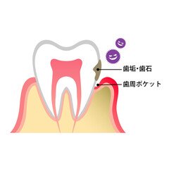 歯周ポケットが汚れ歯周病になっている歯のイラスト