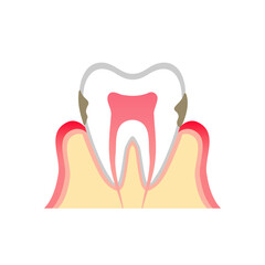 歯周病が進行した歯のイラスト