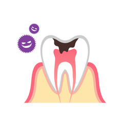 虫歯の断面図のイラスト
