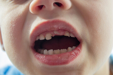 Dental medicine and healthcare - baby teeth with caries