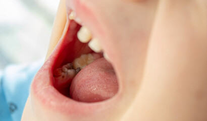 Dental medicine and healthcare - baby teeth with caries