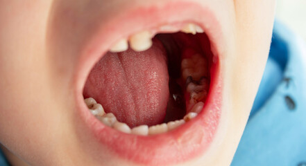 Dental medicine and healthcare - baby teeth with caries