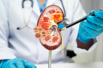 Chronic kidney disease, doctor with model for treatment urinary system, urology, Estimated...