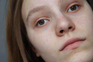 close up portrait of a girl. face of a young woman with strabismus. woman is looking nowhere. 