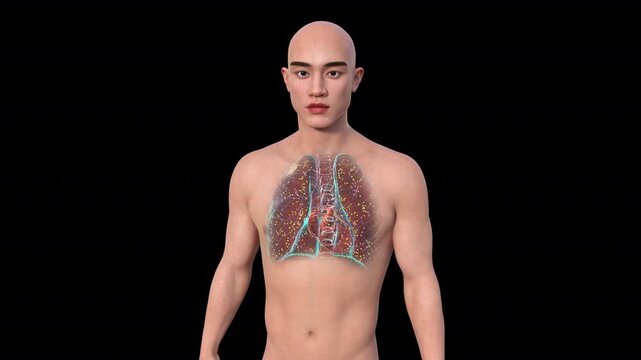 A man with lungs affected by miliary tuberculosis, a disseminated form of tuberculosis characterized by numerous tiny lesions scattered throughout the lungs, 3D animation.