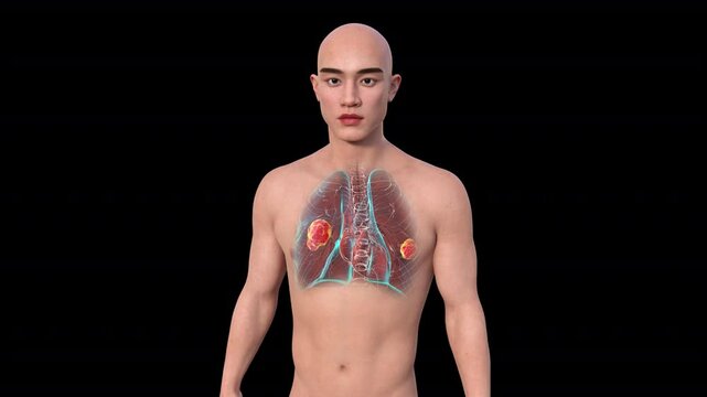 Lung mucormycosis, 3D animation showing fungal infection caused by Mucorales fungi, highlighting multiple irregular lung nodules.