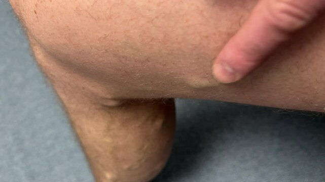 Varicose veins. Phlebology and DVT. Varicose veins on leg of man. Varicosity on legs, spider veins, edema, health illness concept. Phlebeurysm and thrombophlebitis of veins. Phlebology concept. 