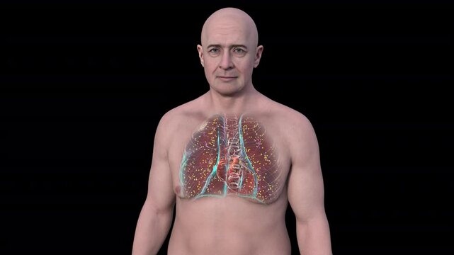 Lung miliary tuberculosis in a middle-aged Caucasian man, 3D animation showing numerous small nodules throughout lung tissue.