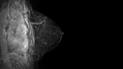 Naklejka premium MRI scan of the breasts in an sagittal view with contrast enhancement.