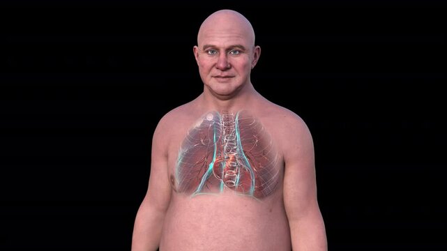 A man with lungs affected by secondary tuberculosis, 3D animation.