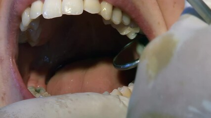 Close-Up of a Dentist Examining Teeth Using a Dental Mirror - 4K