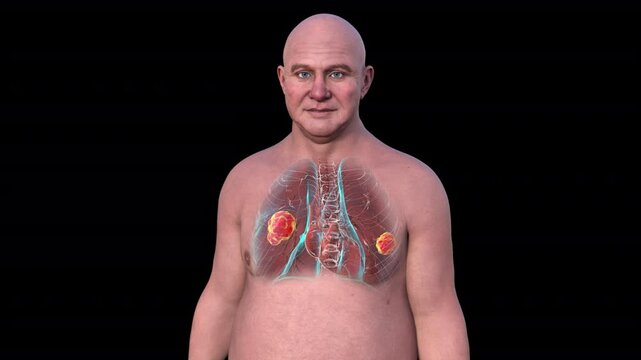 Lung mucormycosis, 3D animation showing fungal infection caused by Mucorales fungi, highlighting multiple irregular lung nodules.