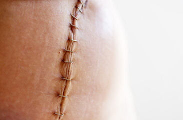 Woman's body with a surgical scar on her abdomen stitched with metal staples after a gynecological...