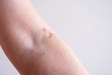 Bruise on the arm of a woman on the flexor joint from a needle, injection, fragile vein after blood...