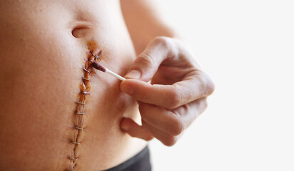 Woman's hands treating with iodine a surgical suture on her belly stitched with metal staples after a gynecological operation hysterectomy or laparotomy, close-up, copy space