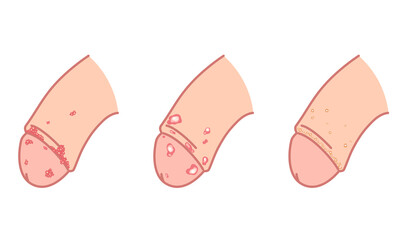 男性生殖器にできたぶつぶつ　性病の種類