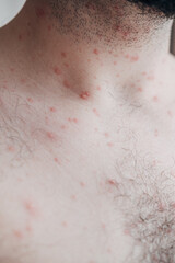 Adult man neck and body with strong aggressive varicella or chicken pox. Pink spots, papules, vesicles. 