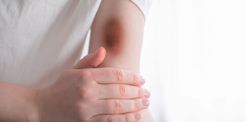 A woman's hand with hematomas after a strong impact, healing process. Bruises on the hand after...