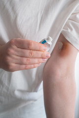 Domestic violence: a woman treats a bruise on her arm with cooling ointment after an argument with her husband.