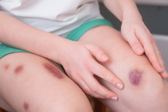 Bruises on the legs are common signs of bumps that require time to heal and fade away with proper care.