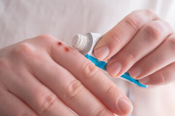 Treating a small wound: woman applies ointment to prevent inflammation and speed up healing on her hand.