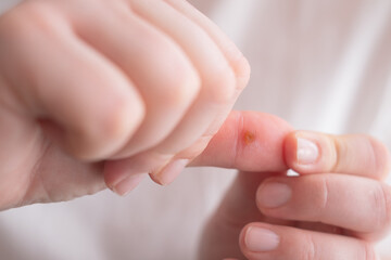 A woman's hand with a wart, a small skin bump caused by a virus, requiring proper care and treatment.