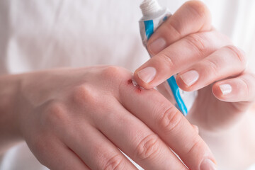 Woman's hand with a small wound being treated with ointment for infection protection and quick healing.