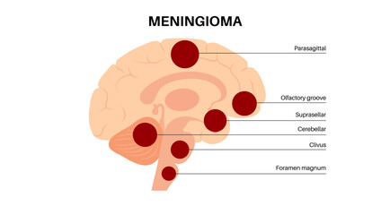Meningiomas cancer poster