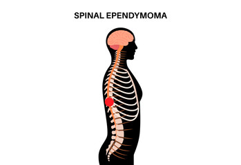 Spinal ependymoma cancer