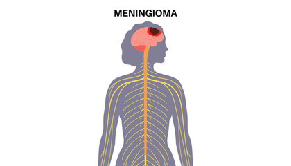 Meningioma cancer concept