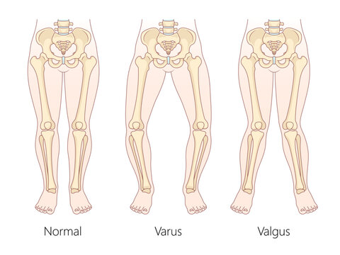 differences between normal leg alignment, varus bowlegged, and valgus knock-knees conditions with skeletal structure diagram hand drawn vector illustration. Medical science educational illustration