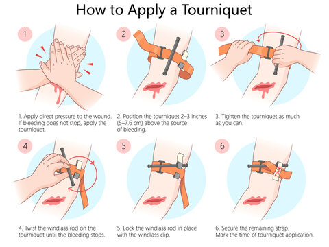 medical infographic demonstrating how to properly apply a tourniquet to stop severe bleeding, using clear step-by-step illustrations diagram hand drawn schematic vector. Medical science educational