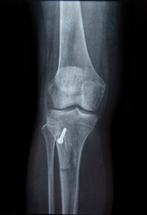 X-ray of a knee with dislocated patella damage and titanium screw prosthesis