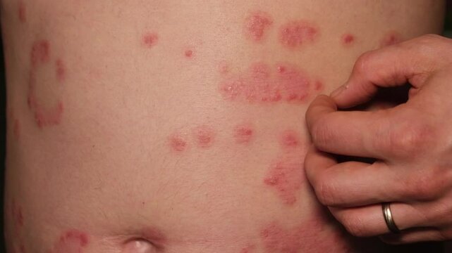 Understanding psoriasis symptoms and skin irritation through detailed examination and patient interaction