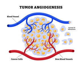 Tumor Angiogenesis, tumors form new blood vessels to supply to  oxygen and nutrients, tumor growth and metastasis. transition of tumors from a benign state to a malignant. Cancer cells.