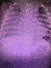 Film x-ray show boot shaped heart the shape heart of the tetralogy of fallot TOF the congenital...