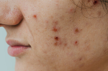 Close-up of a young woman with acne on her face and skin problems.