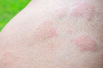 Fototapeta premium Skin allergy rash dermatitis texture close up