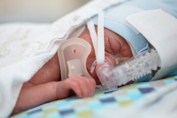 Premature baby with oxygen mask in intensive care unit