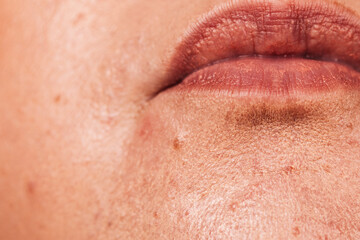 Female face with acne skin problem