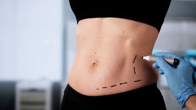 Abdominoplasty Obesity Surgery. Abdominal Fat Liposuction