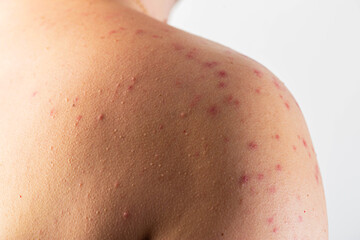 Fototapeta premium Red spots and rashes on the skin of the back and shoulders after drinking alcohol. Anaphylactic shock, alcohol intolerance. Alcoholic urticaria and atopic dermatitis, close-up