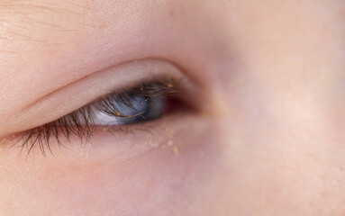 Fototapeta premium Painful red eye of a girl during a viral cold. Inflammation conjunctivitis, macro