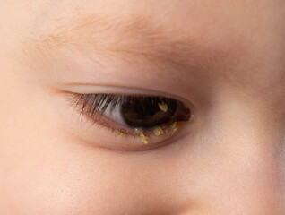 Cutting and pain in the eye of a little boy, pus in the eye. Bacterial and viral infection,...