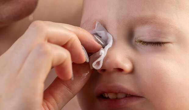 A mother wipes the eyes of a little boy with a cotton pad to remove pus and bacteria due to allergies and conjunctivitis. Eye hygiene for children, close-up